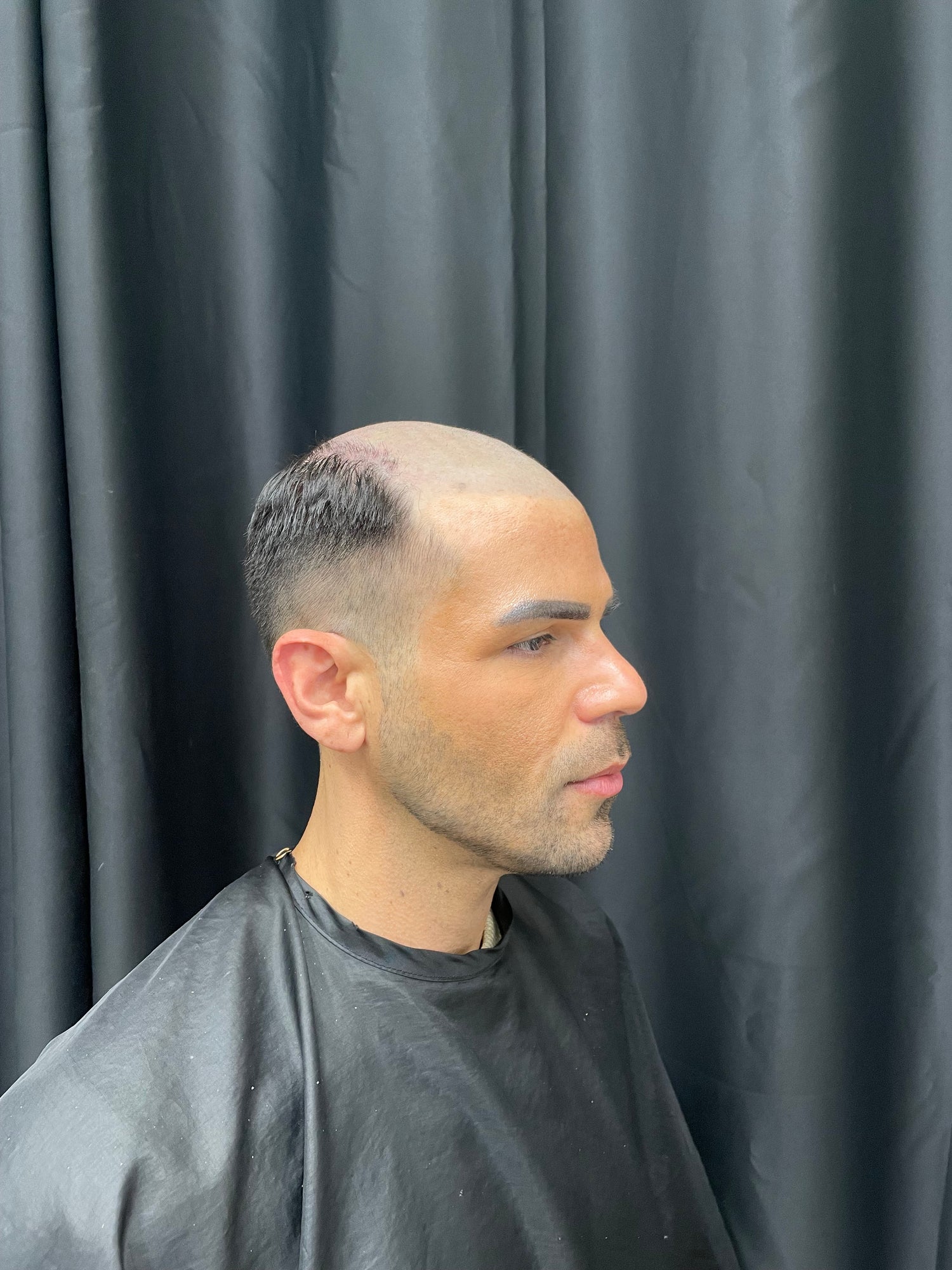 client before photo of hair loss